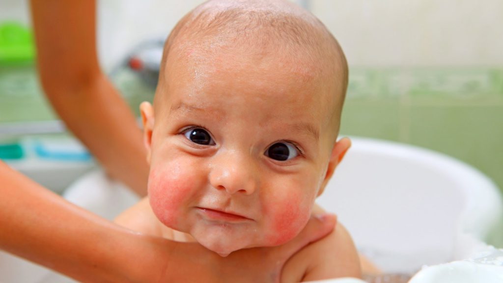 Алергія у дитини грудного віку (на обличчі): від чого може бути, чим небезпечна і що робити
