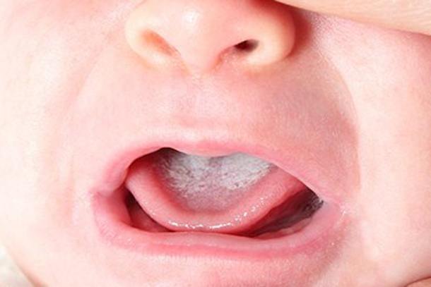Білий наліт на язиці у немовляти: можливі причини, лікування, профілактика