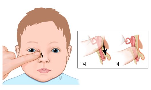 Масаж слізного каналу у новонароджених: як правильно робити фото