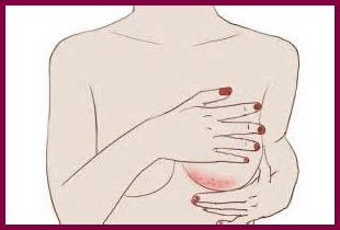 Висип під грудьми і між молочними залозами   що це і як лікувати?
