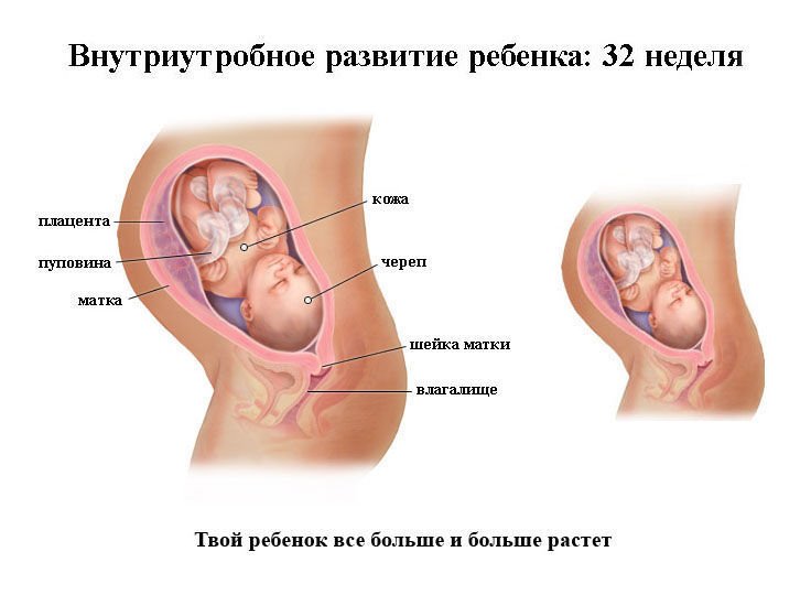 Пологи на 32 тижні вагітності: причини, ознаки, можливі наслідки